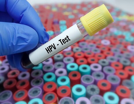 Medical Professional Holding HPV Test Tube for Laboratory Analysis.