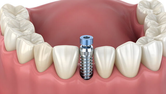 Implante Dental 3D en Boca Humana