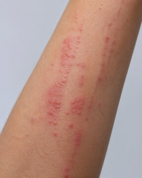 Allergic Contact Dermatitis Rash After Plant Exposure