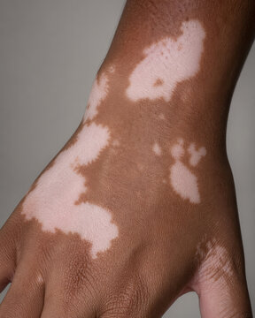 Vitiligo Depigmentation Pattern on Dark Skin Hand