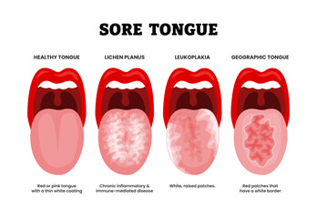 Different types of sore tongue types set collection. Labeled healthy tongue, lichen planus,leukoplakia geographic tongue.Red patches, pink tongue coating, inflammatory disease, white raised patches. © Yumagema