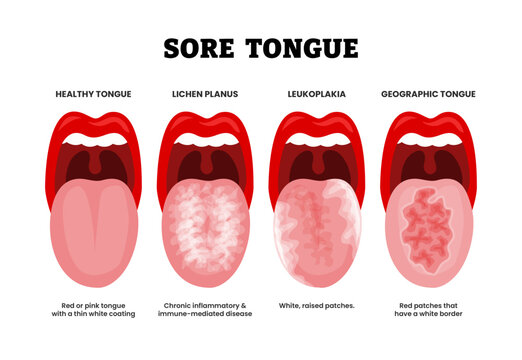 Different types of sore tongue types set collection. Labeled healthy tongue, lichen planus,leukoplakia geographic tongue.Red patches, pink tongue coating, inflammatory disease, white raised patches.