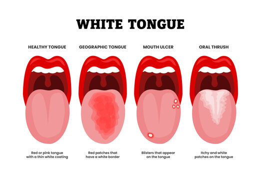 Different types of white tongue types set collection. Labeled healthy, geographic tongue, mouth ulcer and oral thrush. Red patches, blisters, itchy and white coating vector illustration.