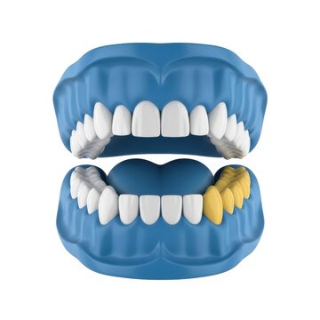 Illustration of dental structure showing a missing molar and wisdom tooth eruption