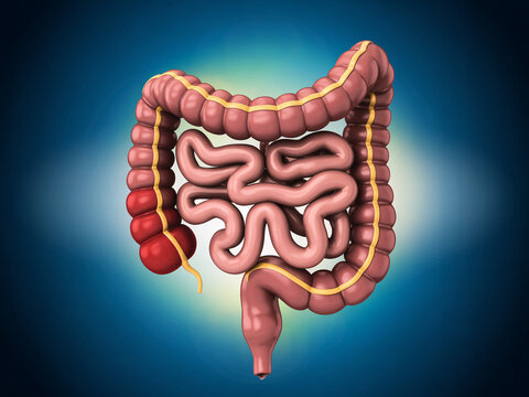 A detailed illustration of the human large intestine with a highlighted section of inflamed diverticula