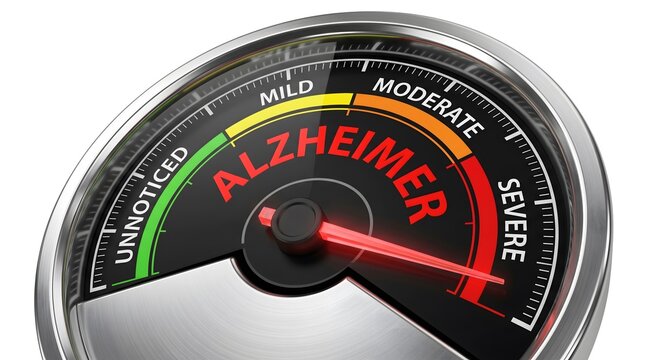 Macroscopic 3D visualization of an Alzheimer's diagnostic gauge indicating a severe stage progression on a polished metallic dial.
