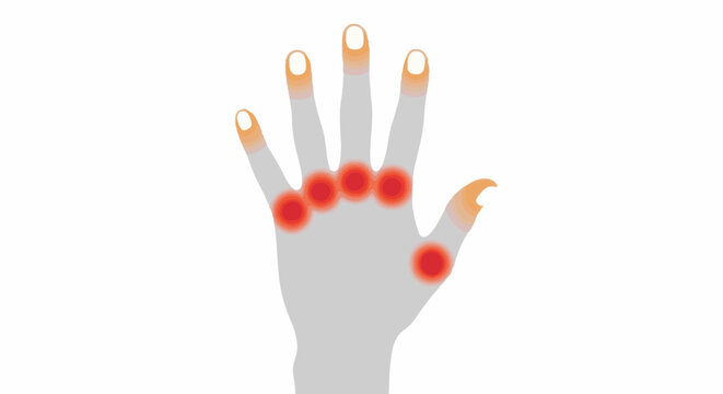 Dorsal view of a hand with highlighted areas of inflammation on the knuckles and finger joints