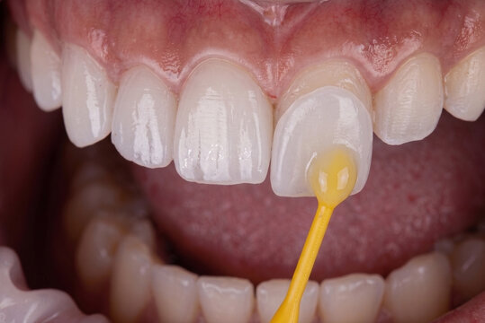 Close-up of a porcelain dental veneer being applied to a tooth with a dental tool for a cosmetic dentistry smile makeover