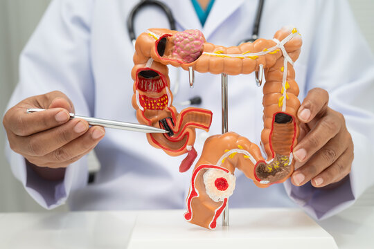 Colorectal cancer, doctor holding intestine colon human model.