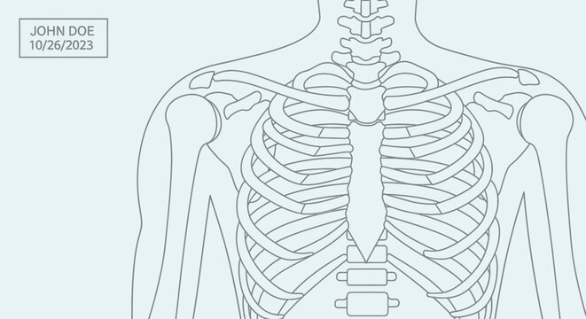 Medical illustration of a human skeletal structure showing the rib cage