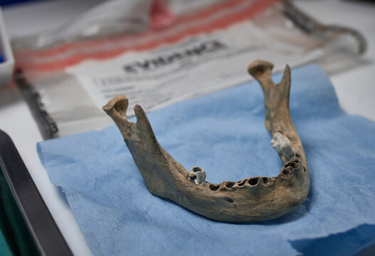 Lower jawbone of a middle-aged adult at a forensic laboratory, homicide investigation