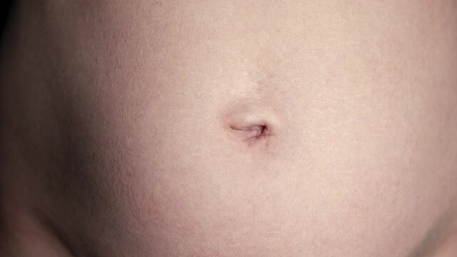 Navel close-up front view. A woman's stomach after pregnancy with stretch marks on the skin. A scar after laparoscopic surgery through the navel. Body part. Postoperative lymphatic edema on a abdomen.