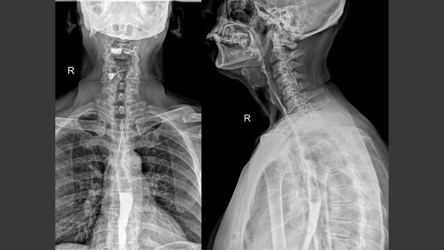 Barium Swallow Study AP and Lateral Radiographs
