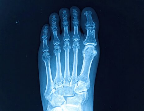 Clear medical X-ray imaging displaying the complete bone structure of an adult human foot viewed from above, useful for diagnostic purposes