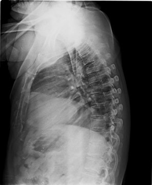 Radiology scan of the human torso featuring the ilium, sacrum, and lumbar vertebrae in high detail.
