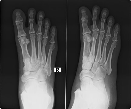 Radiographic view of a human foot and ankle joint for orthopedic diagnostic evaluation of bone structure.