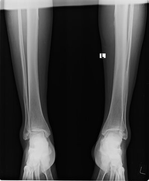 Radiographic imaging of the lower leg including the patella, tibia, and tarsal bones for orthopedic diagnostic analysis.