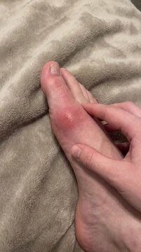 Acute arthritis crisis: gouty inflammation, big toe, joint pain, uric acid, crystal deposit, body ailment, foot discomfort, medical problem.