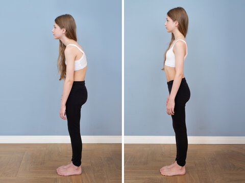 Good posture and bad posture girl, side view. Problems of slouching, curvature of the spine