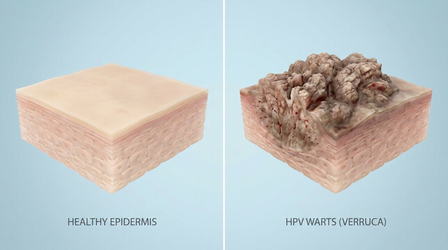 Healthy Epidermis Versus HPV Warts Verruca Skin Infection Comparison