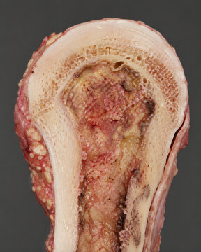 Chronic Osteomyelitis with Sequestrum and Involucrum