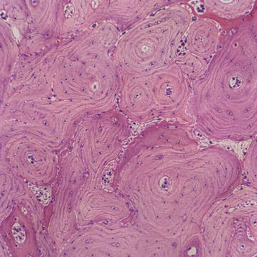 Paget Disease Mosaic Pattern of Lamellar Bone Histology