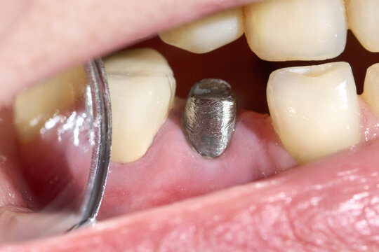 Dentist using mirror to inspect dental implant abutment inside mouth demonstrating oral care and clinical examination