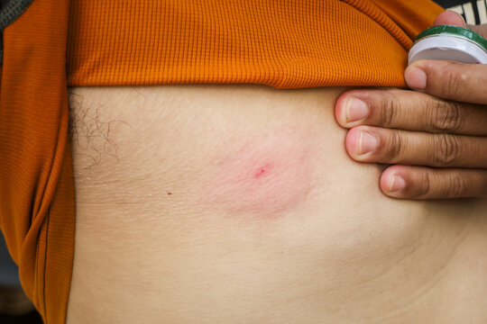 Close up view of painful red scorpion sting mark on bare chest of distressed man showing severe skin swelling and intense inflammation after dangerous venomous insect bite injury
