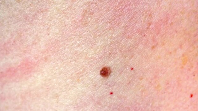 Skin tag attached to the elderly person body close-up. Selective focus a harmless polypoid outgrowth, a hanging mole, soft fibroma or acrochordon. Growth hangs from small stalk or peduncle.