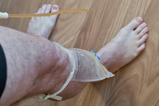 The bladder catheter and the urine collection bag fixed on the patient leg. Urology, urinal system, prostate, mans healt concept