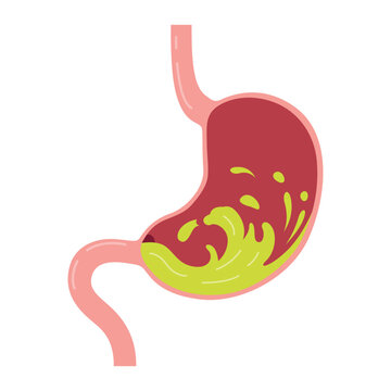Vector illustration of an unhealthy stomach experiencing heartburn or gastritis on a white background with a clear depiction of discomfort. Concept of pain, indigestion, or stomach upset.