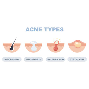 Acne types diagram blackheads whiteheads inflamed cystic. vector illustration
