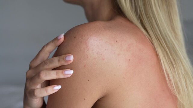 Young blonde woman touching shoulder with irritated skin and small pimples. Close up of body acne after sun exposure or hormonal imbalance. Skincare and sensitive skin concept