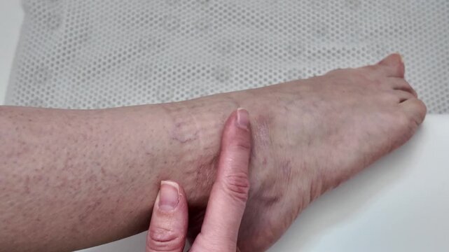 Close-up of female foot with sock marks on skin. Visible pressure lines from tight socks on woman&rsquo;s leg and ankle. Healthcare, circulation, discomfort, and everyday life concept