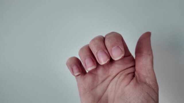Close-up of damaged and broken fingernails on human hands. Unhealthy brittle nails with visible imperfections. Beauty, healthcare, manicure problem, and nail care concept