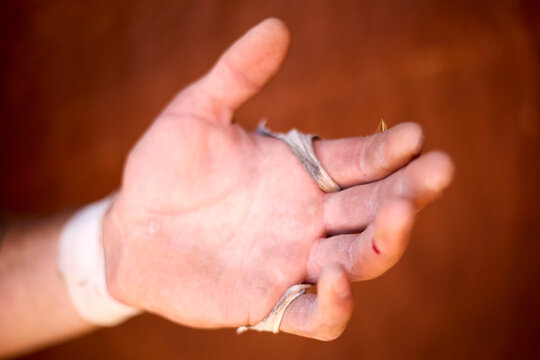 Gymnast hand showing ripped callus and blood