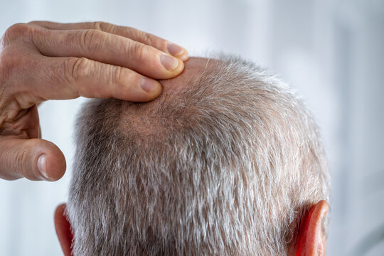 Mature bald man facing hair loss, no comb needed, considering trichology solutions, male baldness and growing need professional hair restoration, Hairless head, seeking medical help regrowth therapy