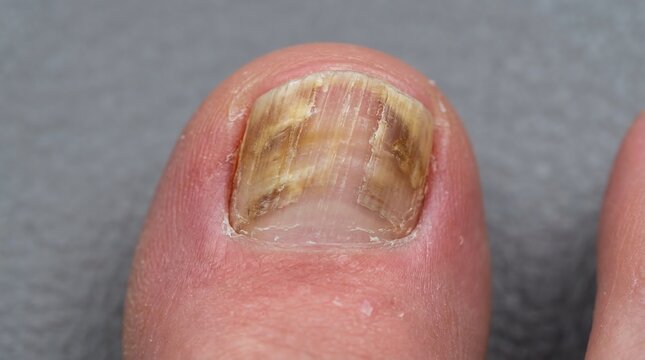 Onychomycosis Fungal Infection Displaying Severe Discoloration and Thickening on a Human Toenail Closeup