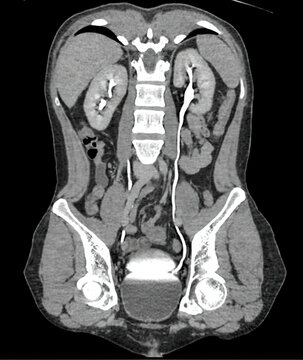 CT Scan Showing Renal Calculus in the Kidney