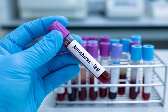 Hand in blue medical glove holding blood sample tube labeled amoebiasis test