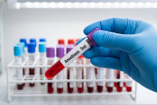 Scientist holding a blood sample for an amoebiasis screening test in a medical laboratory