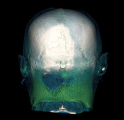 3D CT scan of skull with color segmentation showing cranial and facial bones. © Amri