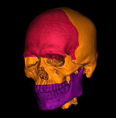 3D CT scan of skull with color segmentation showing cranial and facial bones. © Amri