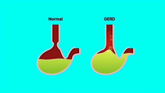 Medical diagram comparing a healthy stomach to one with gerd showing acid reflux rising into the esophagus.