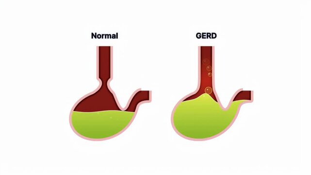 Medical diagram showing the difference between a healthy stomach and gastroesophageal reflux disease with rising acid