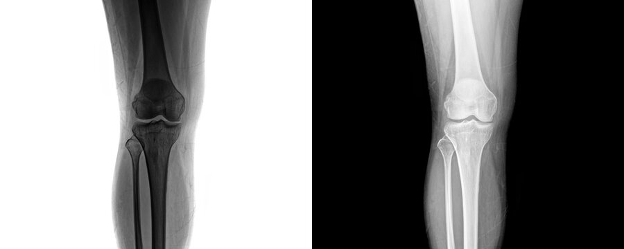 Medical Knee Joint Anterior X-ray Image Showing Clear Femur, Tibia, and Patella Alignment for Assessment of Degenerative Arthritis Isolated on Transparent Background