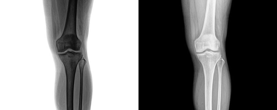 Diagnostic Knee Joint X-ray Anterior View Showing Femur, Tibia, and Patella Alignment for Evaluation of Arthritis Pain Isolated on Transparent Background
