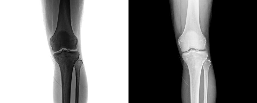 High Resolution Medical Knee Joint X-ray Anterior View Showing Structural Changes for Arthritis Diagnosis Isolated on Transparent Background