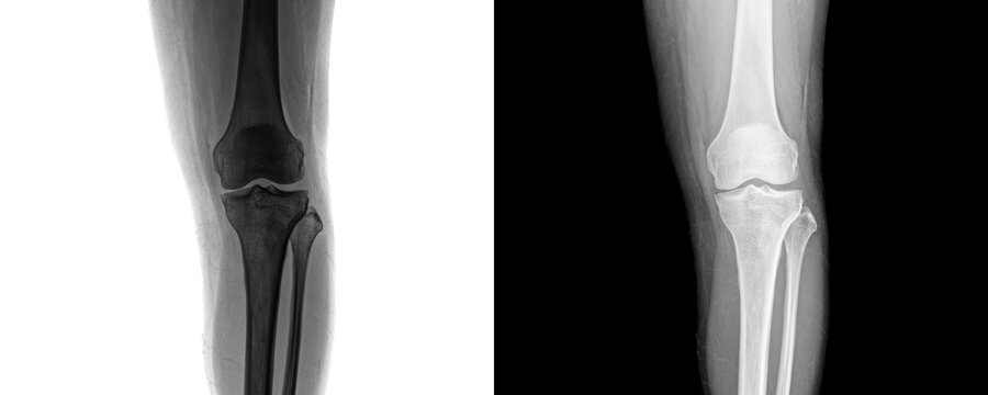 Clinical Knee Joint Anterior Projection X-ray Showing Bone Structure for Arthritis Assessment Isolated on Transparent Background
