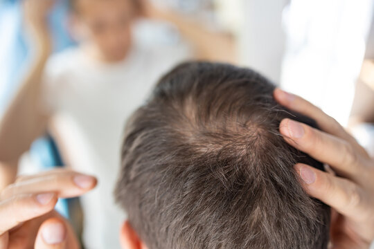 Top View of a Man&rsquo;s Head Showing Early Stages of Hair Loss or Thinning Hair at the Crown